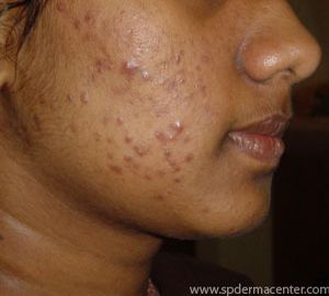 Acne-Before